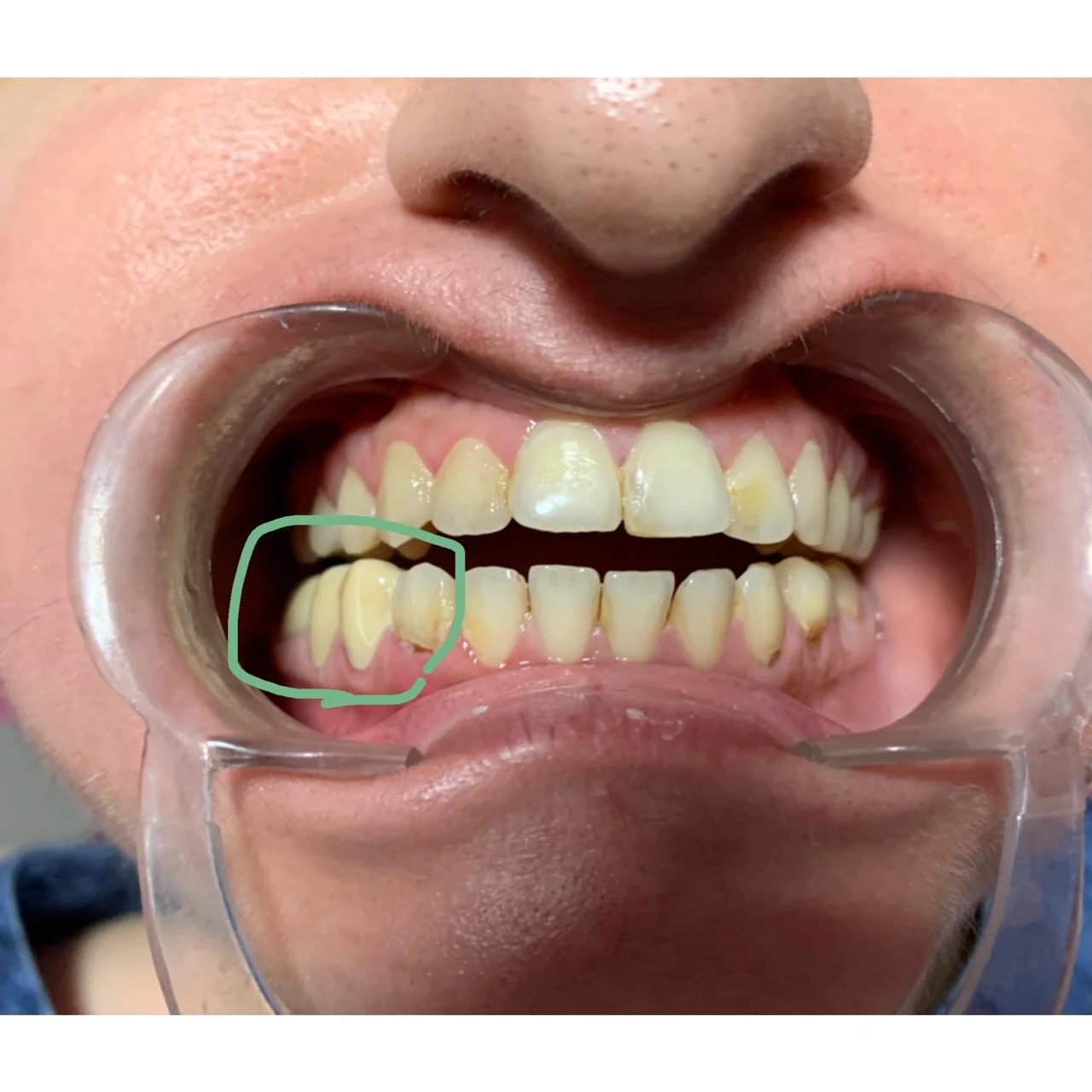 An intraoral photograph with a lower tooth marked in green.